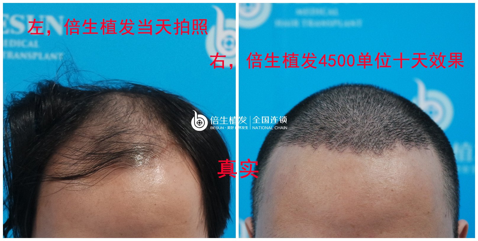 男生植发是一个怎样的体验？在广州倍生植发做了4500单位植发