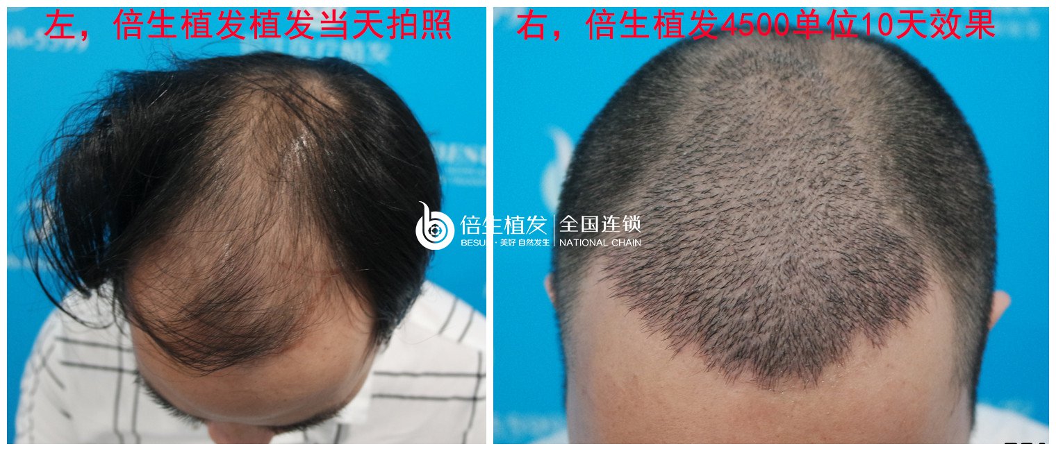 男生植发是一个怎样的体验？在广州倍生植发做了4500单位植发